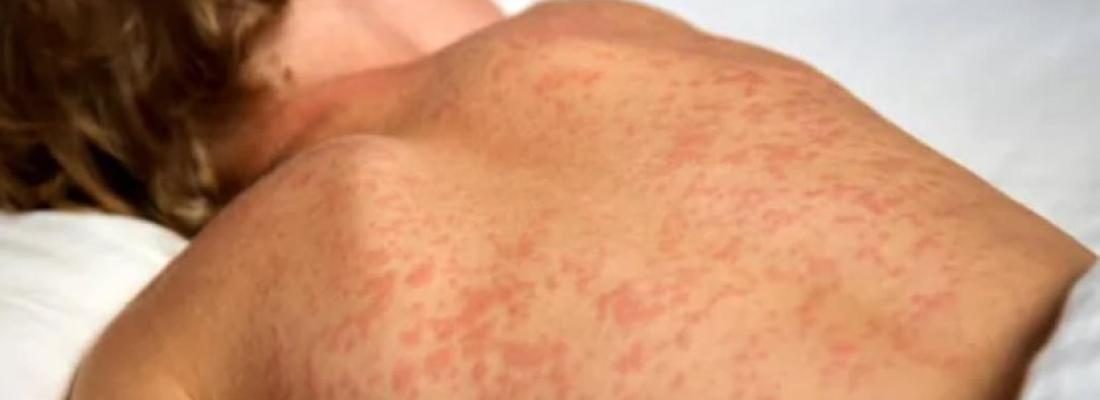 A child infected with measles. (Photo via Facebook.) A child infected with measles. (Photo via Facebook.)